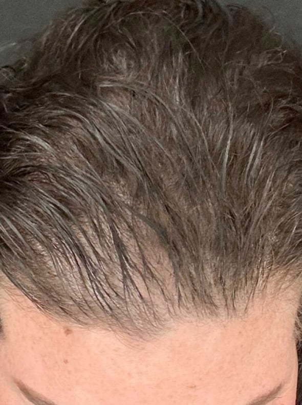 Advanced Hair System Kit